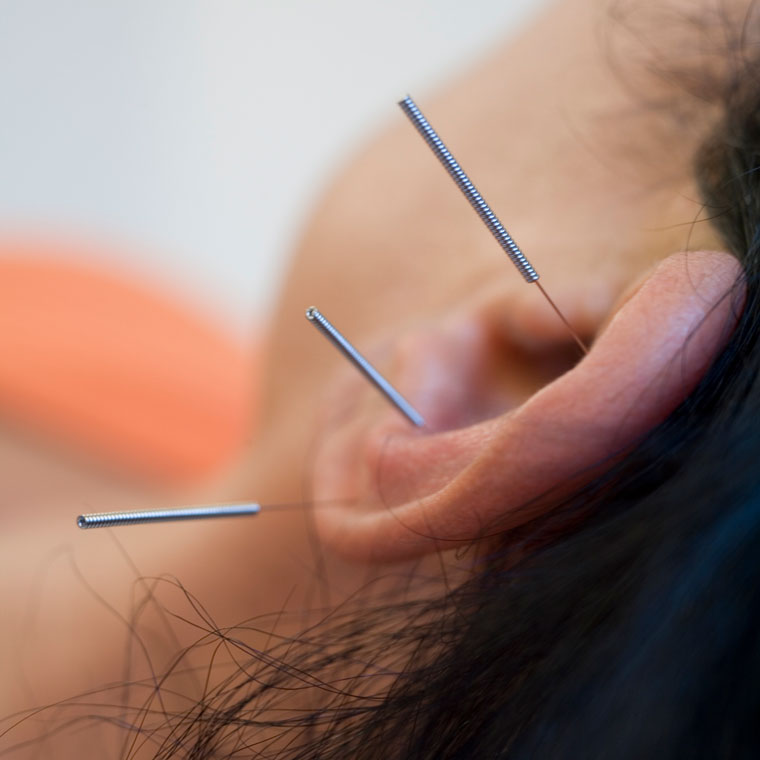 Akupunktur Traditionelle Chinesische Medizin TCM Akupunktur Traditionelle Chinesische Medizin TCM